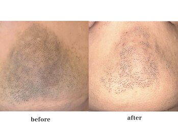 カヌヌ(kanunu)/メンズ脱毛/髭・顔