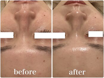 リリィブラン(Lily branc)/毛穴洗浄ピーリング