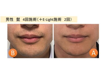 ラグゼ(LUXE)/ひげ脱毛も初回半額!