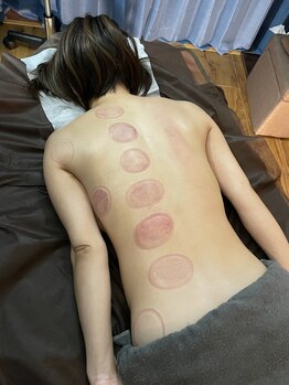 タオ(TAO)/カッピング痕が残ります