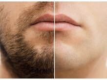 ナルフロウ(nalufurou)/ヒゲ脱毛/メンズ脱毛/全身脱毛