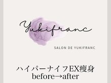 サロン ド ユキフラン(Salon de Yukifranc)/ハイパーナイフEX痩身術