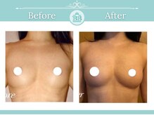 美人バスト 千早店/バストアップ◇育乳症例◇