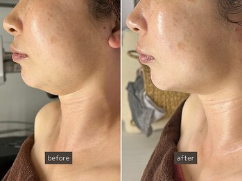 SEC(Shizuoka esthetic company)/【小顔】たるみ・むくみ改善◎