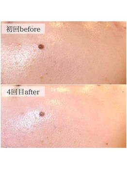 サロン ド ブラン アオヤマ(Salon de BLANC AOYAMA)/ハーブピーリング×超音波マシン