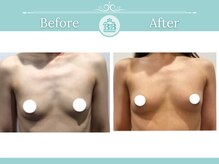 美人バスト 表参道店/【バストアップ/育乳 症例】