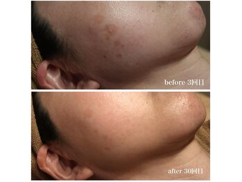 ベビースキン(baby skin)/シミ改善