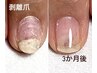【初回限定】トラブル爪、剥離爪、凹凸爪、変形爪