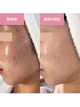 リシェル(Richelle)/ 【GREENPEELメラウェーブ】