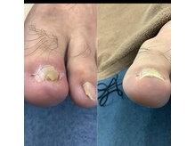 【巻き爪/深爪/フットケア】巻き爪本舗　津田沼店/埋まっている爪でもOK！