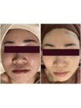 フォーユー マシバメディカル(For You Mashiba Medical)/セルマン艶玉肌トリートメント