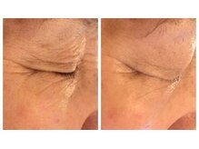 ビプラス(VIPLAS)/プラズマ（しわたるみケア）