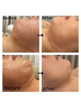 インディバケアプラチナム 横浜店/インディバ施術