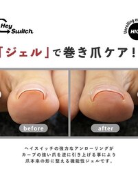 巻き爪ケア+フットマッサージ付