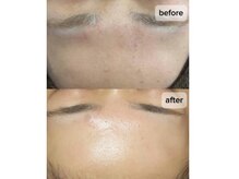 チェルト 鈴鹿店(CERTO)/REVIハーブピーリング