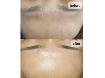 チェルト 鈴鹿店(CERTO)/REVIハーブピーリング