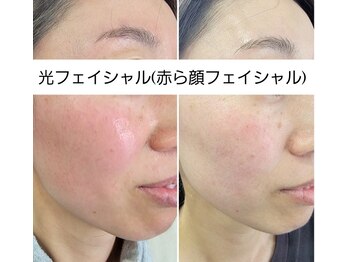 サロン ベル(Salon B'elle)/光フェイシャル(赤ら顔用)