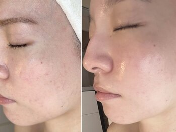 サロン エデンプラス(salon eden PLUS)/敏感肌ニキビケアも通う程に美肌