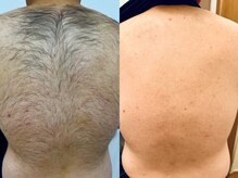 シャルム(Charme)/脱毛before after