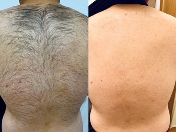 シャルム(Charme)/脱毛before after