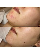 エクラムサロン 代官山(eclam salon)/施術BEFORE／AFTER