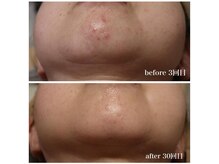 ベビースキン(baby skin)/肌改善