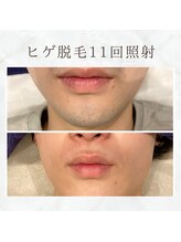 ボゴス(BOGOSS)/ヒゲ脱毛11回照射