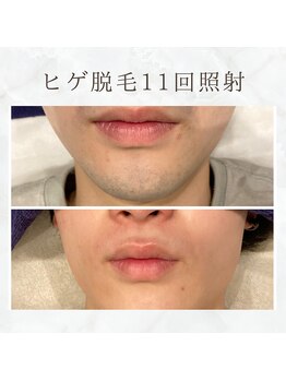 ボゴス(BOGOSS)/ヒゲ脱毛11回照射