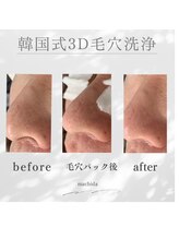 ホワイトニングショップ 町田店/毛穴洗浄ビフォーアフター1回