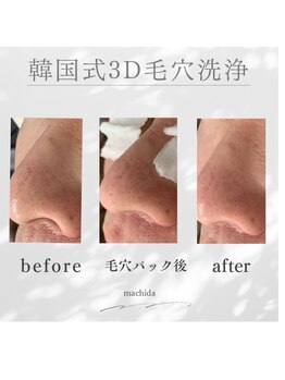 ホワイトニングショップ 町田店/毛穴洗浄ビフォーアフター1回