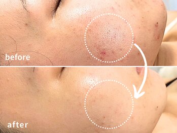 ソレイユ(Soleil)の写真/毛穴・黒ずみここまで変わる｜クレンジングや洗顔では落ちない"詰まりの根本"にアプローチするピーリング
