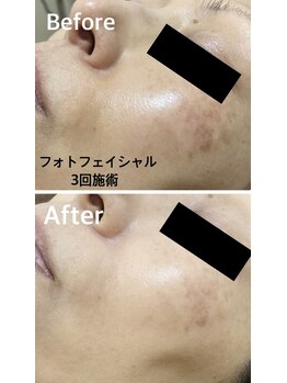 リアン 長久手店(Rian)の写真/どんな肌悩みにもお応え◎肌力を底上げし、自信あふれる美肌へ♪嬉しいドライヘッドスパ付き