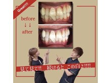 ホワイトニングプラス(Whitening+)/一日で白くなるのも夢じゃない！