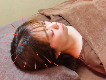 アルバ暁子鍼灸治療院(alba暁子鍼灸治療院)/頭鍼