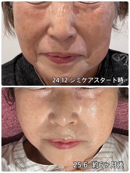 レイール(Reir)/しみ、シワまでスッキリつや肌☆