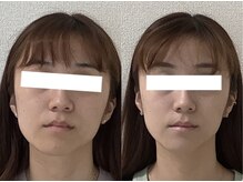 エミルカ 仙台(EMILUCA)/美顔筋リフト