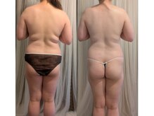 ポノ(pono)/背中BeforeAfter