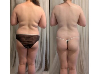 ポノ(pono)/背中BeforeAfter