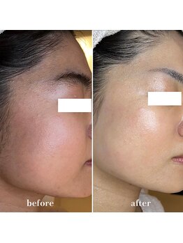 エクラムサロン 代官山(eclam salon)/施術BEFORE／AFTER