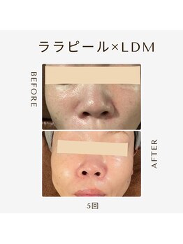 ツヤハダコガオ 千葉店/before⇒after 【ララピール】