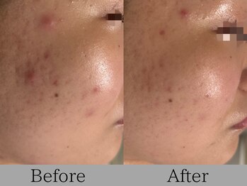 ルミライズ(lumirise)/〈5回目での効果〉