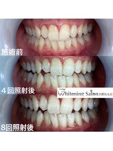 ホワイトニングサロン 京都烏丸店/ホワイトニング施術例