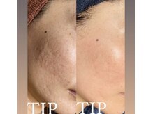 ムーンリズム(Moonlism)/【TIPハーブ症例】ニキビ・跡