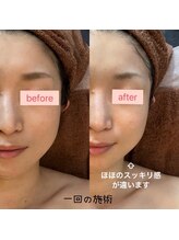 ルミナス(LUMINOUS)/1回60分の施術でこの引き上がり