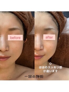 ルミナス(LUMINOUS)/1回60分の施術でこの引き上がり