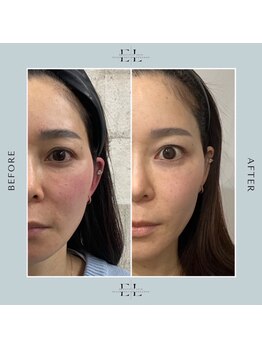 ホワイトラボ 姫路(White labo)/【施術例】エクソリフト/ExoLift