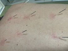 エザキ鍼灸院 接骨院(EZAKI鍼灸院 接骨院)/世界保健機関が効果を認める鍼灸