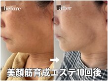 リエル(RIEL)/小顔矯正×美顔筋育成エステ