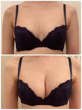 美人バスト 本厚木店/バストアップ◇症例◇