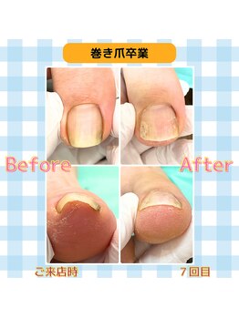 巻き爪補正店 富山店/巻き爪卒業
